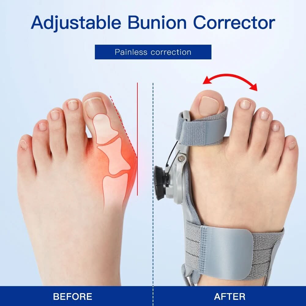 Corrigeer uw bunions zonder pijn of operatie 